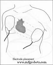 Défibrillateur externe : histoire, conception et fabrication
